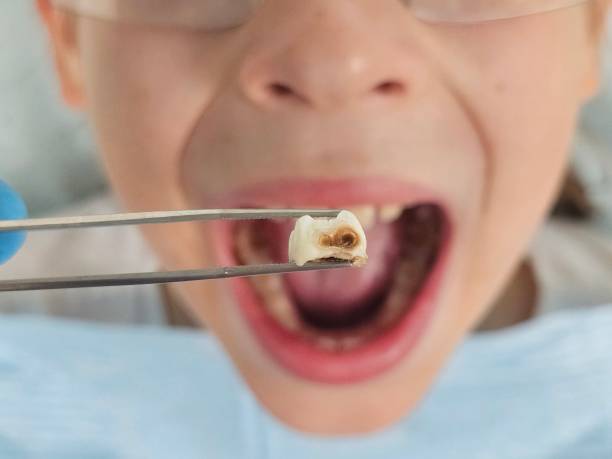 Best Emergency Dental Extractions in Shrewsbury, NJ